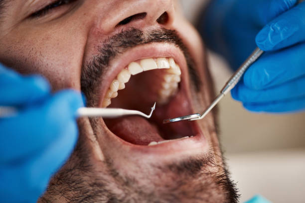 Best Emergency Dental Care for Broken or Chipped Teeth in Bexley, OH